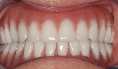 Close up of complete smile after getting implant dentures